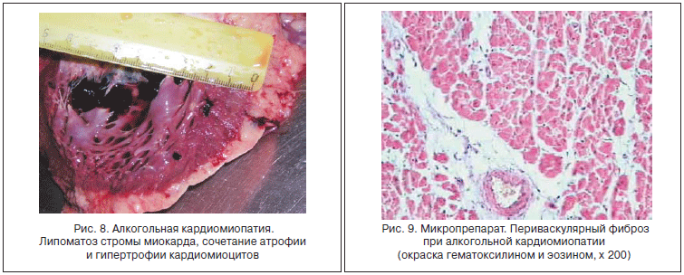 Алкогольная кардиомиопатия и периваскулярный фиброз